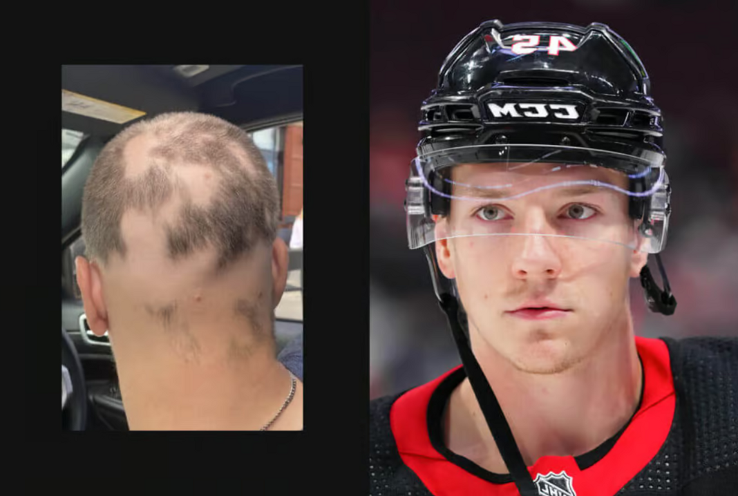 Wstydliwy problem hokeisty NHL. Jego organizm zwalcza… włosy