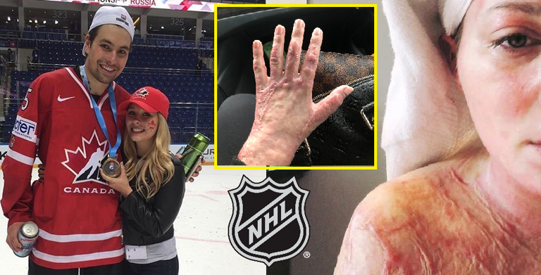 Koszmarny wypadek na imprezie u hokeisty NHL. Człowiek zapłonął jak świeca